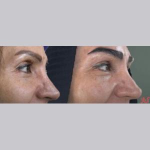 کاشت مو و ابرو با پرداخت 8 تومن و قسطی