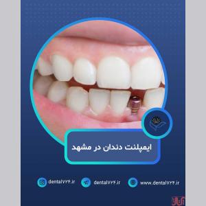 ایمپلنت دندان در مشهد با اقساط بلندمدت و شرایط ویژه